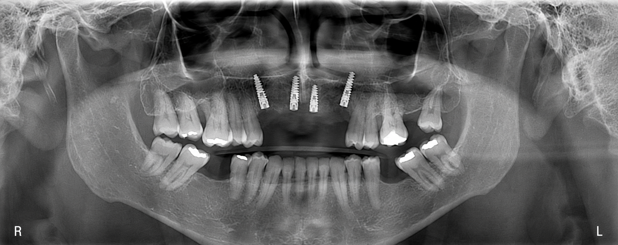Radiografía panorámica anonimizada de un caso de implantes dentales